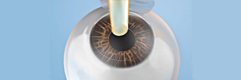 Эпи ЛАСИК (Epi LASIK) - лазерная коррекция зрения