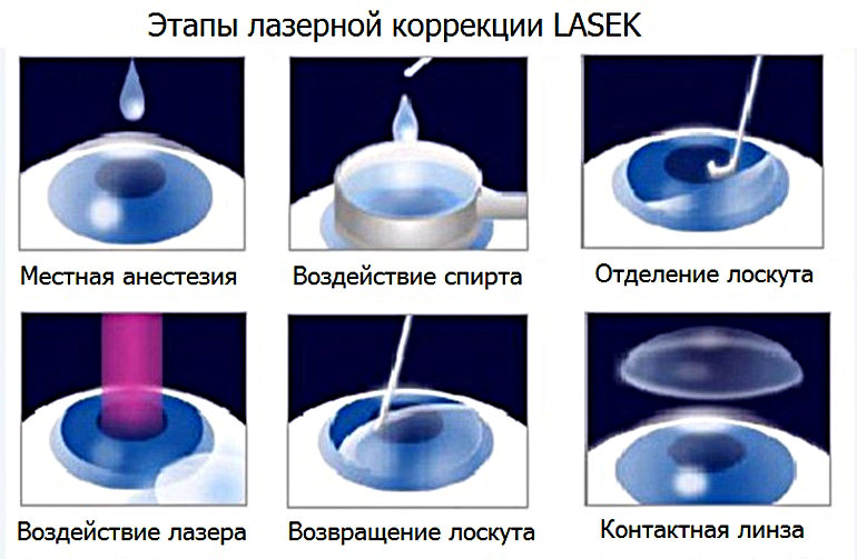 LASEK - лазерная субэпителиальная кератэктомия