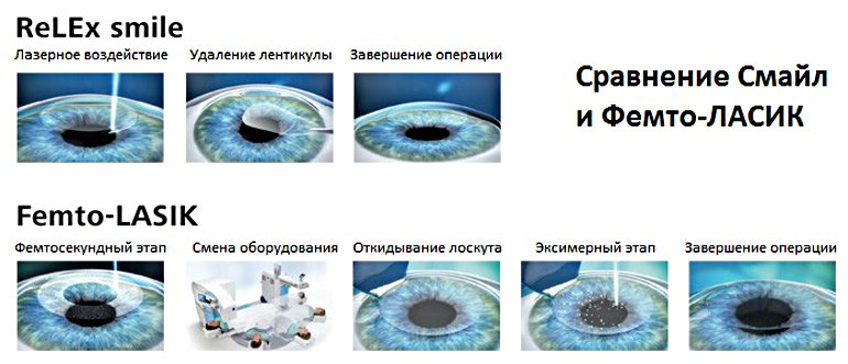 Отличие методов коррекции зрения смайл и фемто-ласик