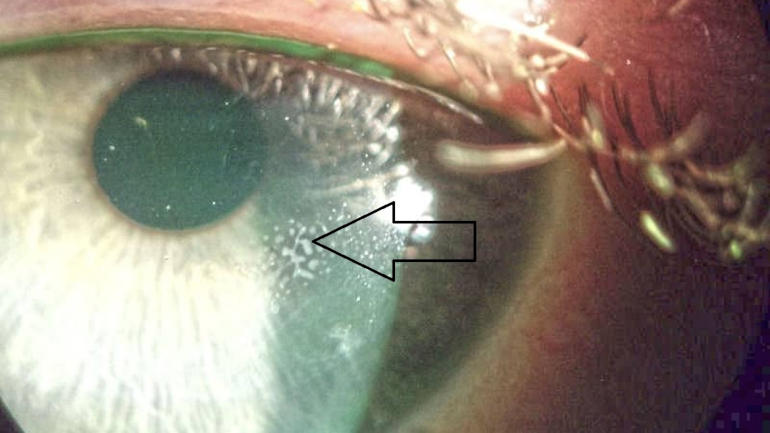 Осложнения лазерной коррекции зрения LASIK - врастание эпителия под лоскут
