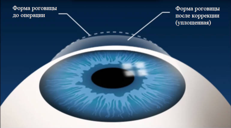 Осложнения после лазерной коррекции зрения – чем может быть опасна, какие есть риски и последствия