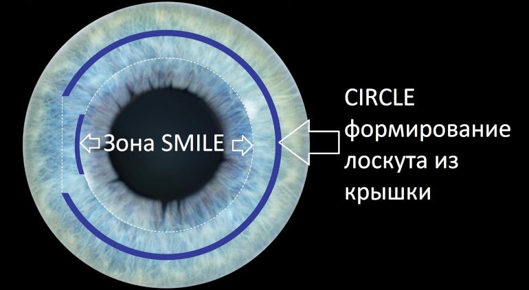 Схематическое изображение работы модуля CIRCLE в лазере VisuMax (формирование флэпа)