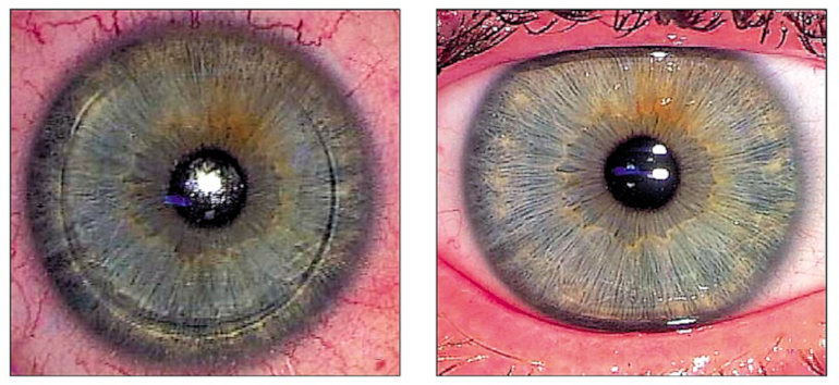 Глаз после лазерной коррекции зрения ЛАСИК - через 1 час и через 1 день