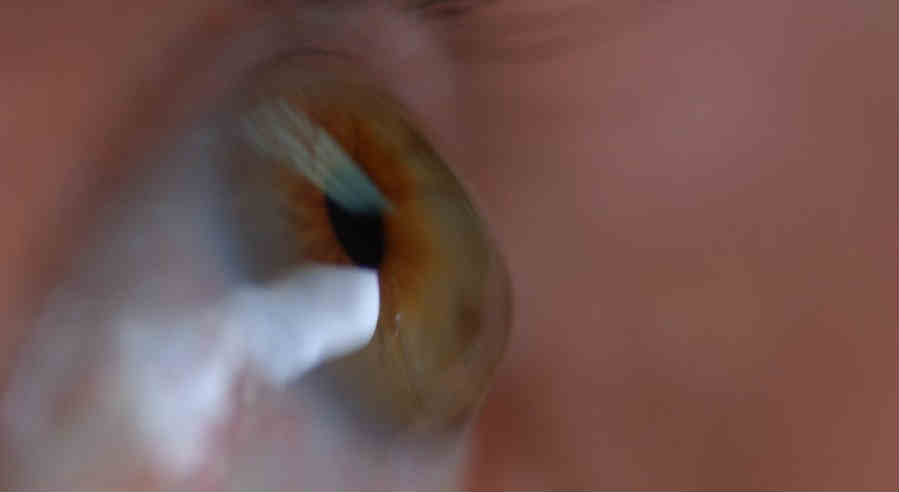 Кератоконус лазерной коррекции зрения
