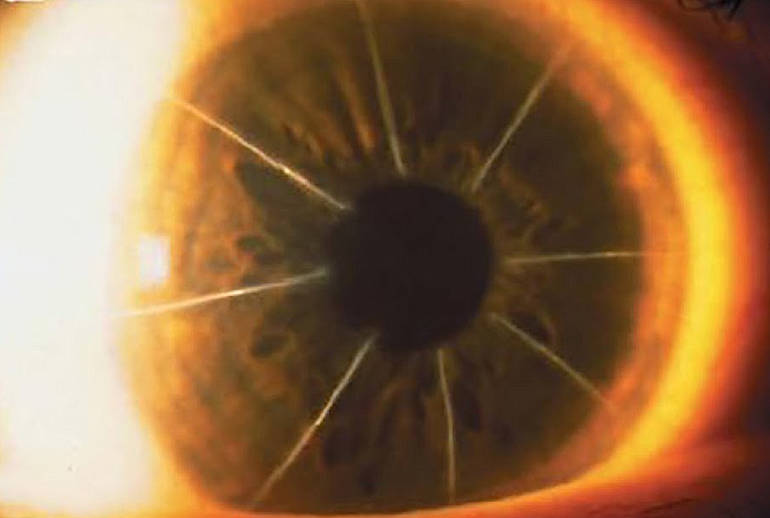 Лазерная коррекция зрения после кератотомии (насечек на роговице глаза)