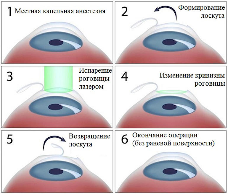 Метод лазерной коррекции зрения ЛАСИК (LASIK)