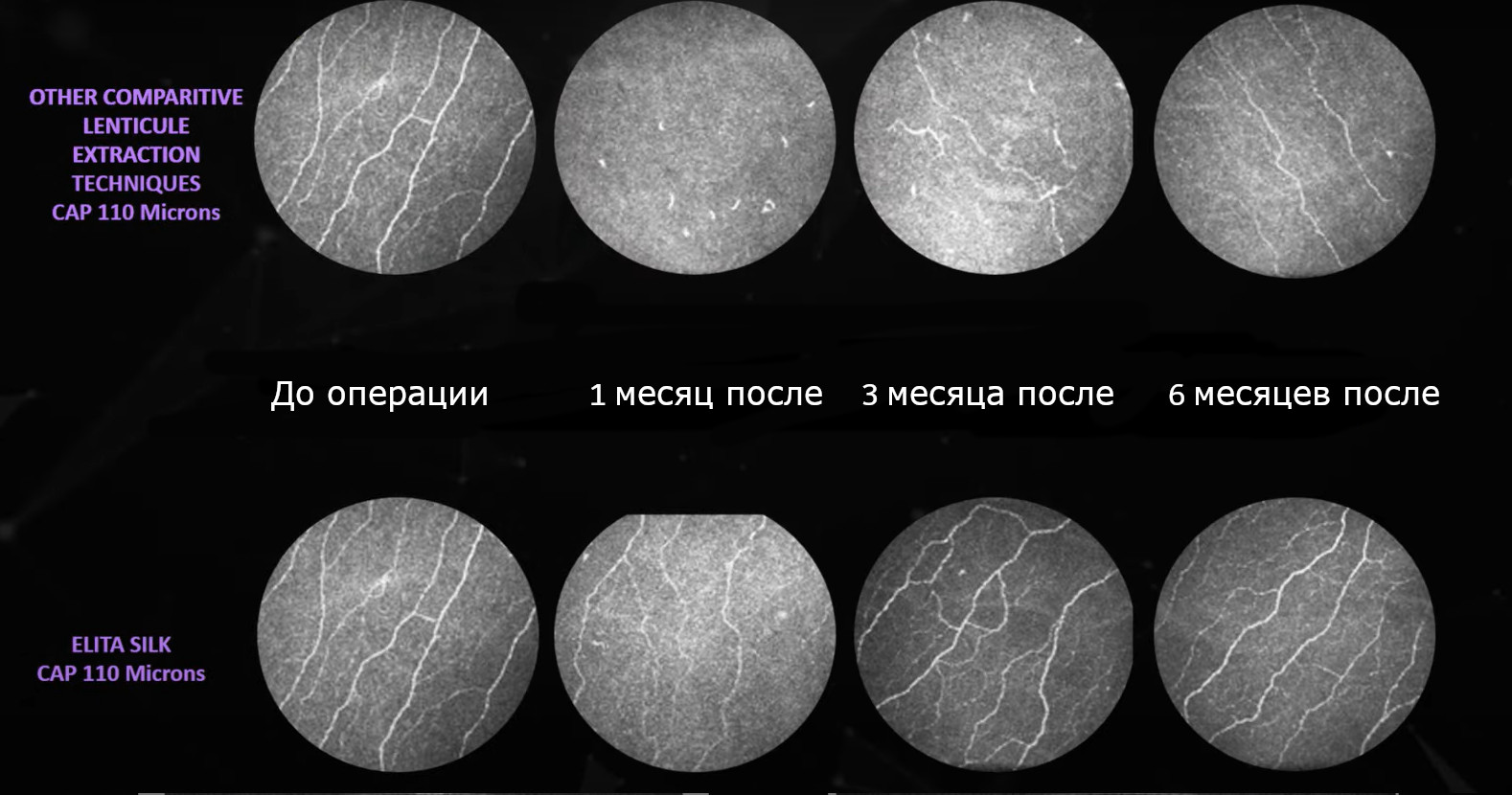 Сравнение количества нервных волокон при традиционных методах лазерной коррекции зрения и SILK