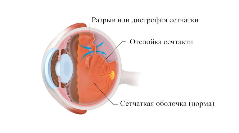 Самостоятельные роды или кесарево сечение при разрывах и дистрофиях сетчатки глаза