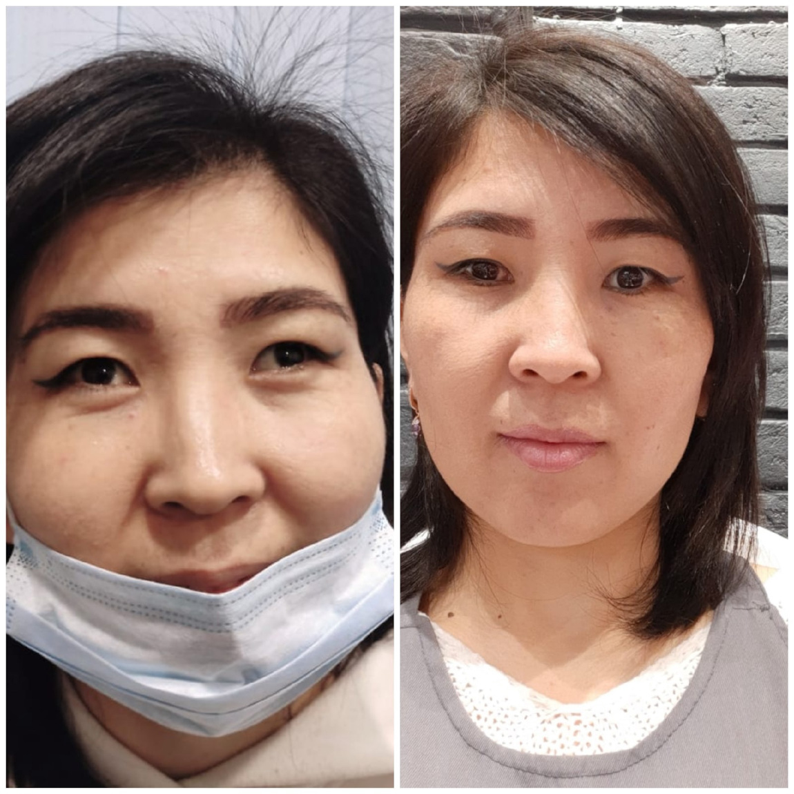 Отзыв и фото до и после операции по исправлению косоглазия