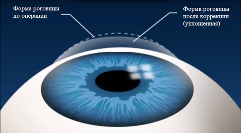 Принцип лазерной коррекции зрения - изменение формы роговицы глаза