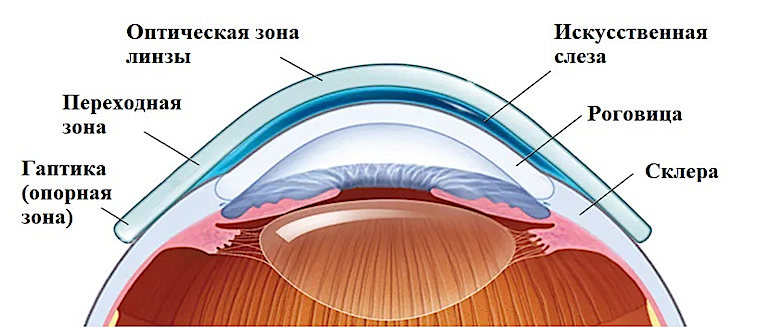 Жесткие склеральные линзы при кератоконусе подбор в Москве